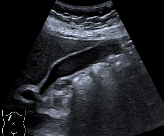 كسل المرارة: عندما تضعف الحركة دون وجود حصوات